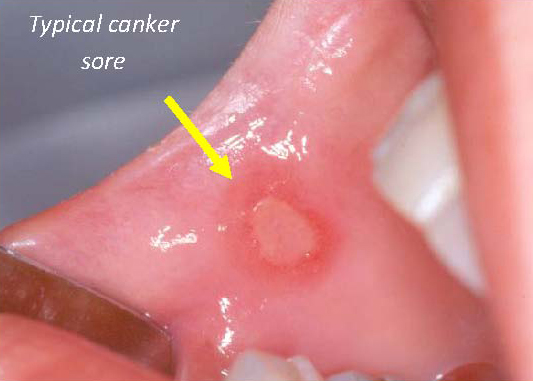 Cankers In The Mouth 18