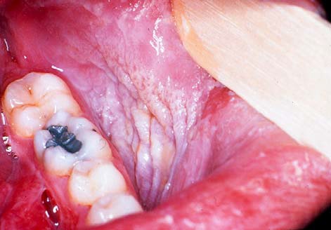 hairy tongue from chewing tobacco