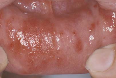 urticaria mouth