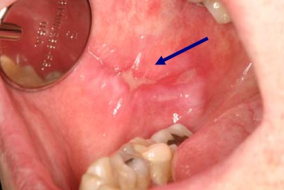 What does allergic reaction in mouth look like