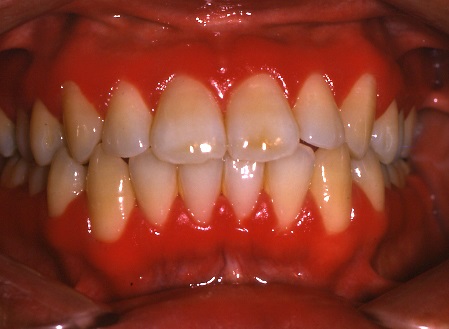 Allergic reaction in mouth and gums