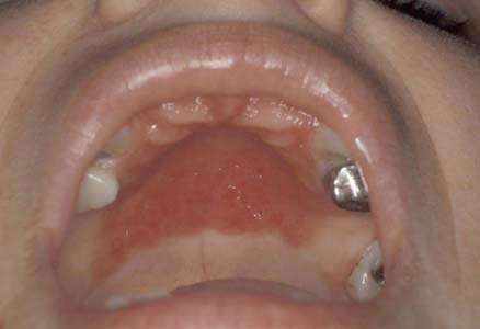 yeast infection in mouth