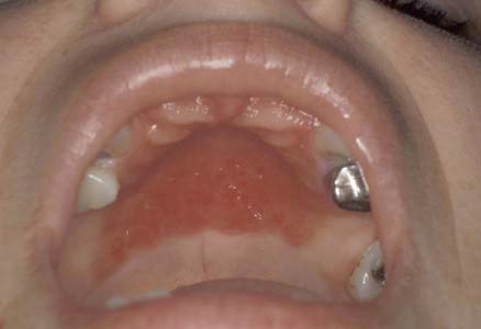 can you catch oral thrush