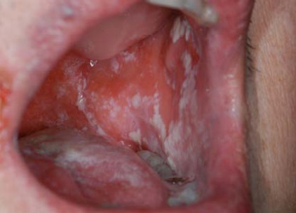 thrush infection in mouth