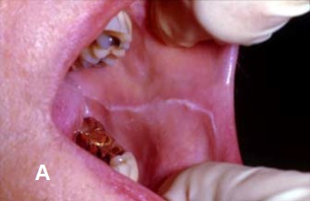 White Oral Lesion 113