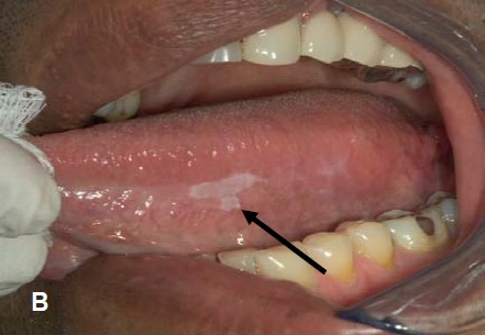 Little white bump under tongue? : r/DentalHygiene