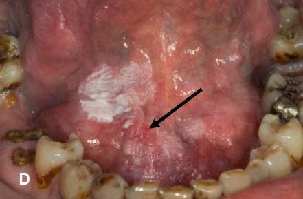 erythroplakia floor of mouth