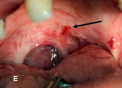 What Does Mouth Cancer Look Like 5 Pictures Of Mouth Cancer