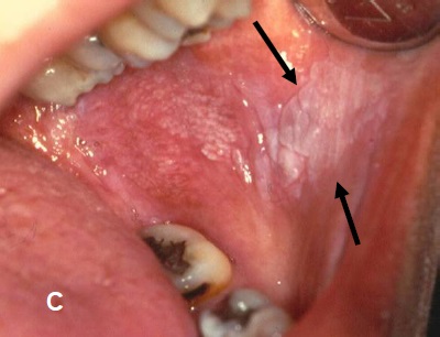 White Lesion In Mouth 39