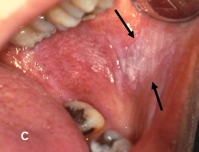 erythroplakia floor of mouth