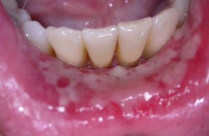 soft palate canker sore