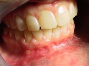 soft palate canker sore